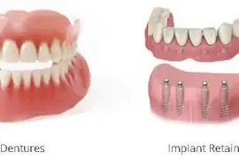 The Pros And Cons Of Snap On Dentures | Dentist of