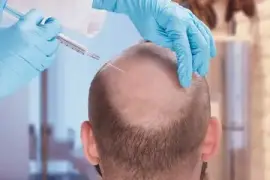 Get Your Hair Back! FUE Hair Transplant in the UK