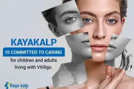 Kayakalp Global, Offer Best Medicine for Vitiligo 