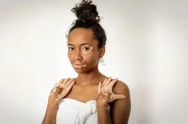 Vitiligo And Skin Cancer Risk: What You Need To Kn