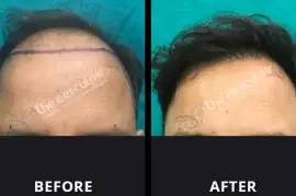 Best Hair Transplant Surgery in Delhi