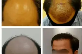 Best Hair Transplant Surgeon in Bengaluru