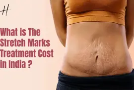 prp injection for stretch marks cost