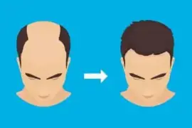 Dr. A'S Clinic for Hair Transplant Clinic in Delhi