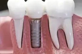 Dental Implant in Los Angles | Dentist of Woodland